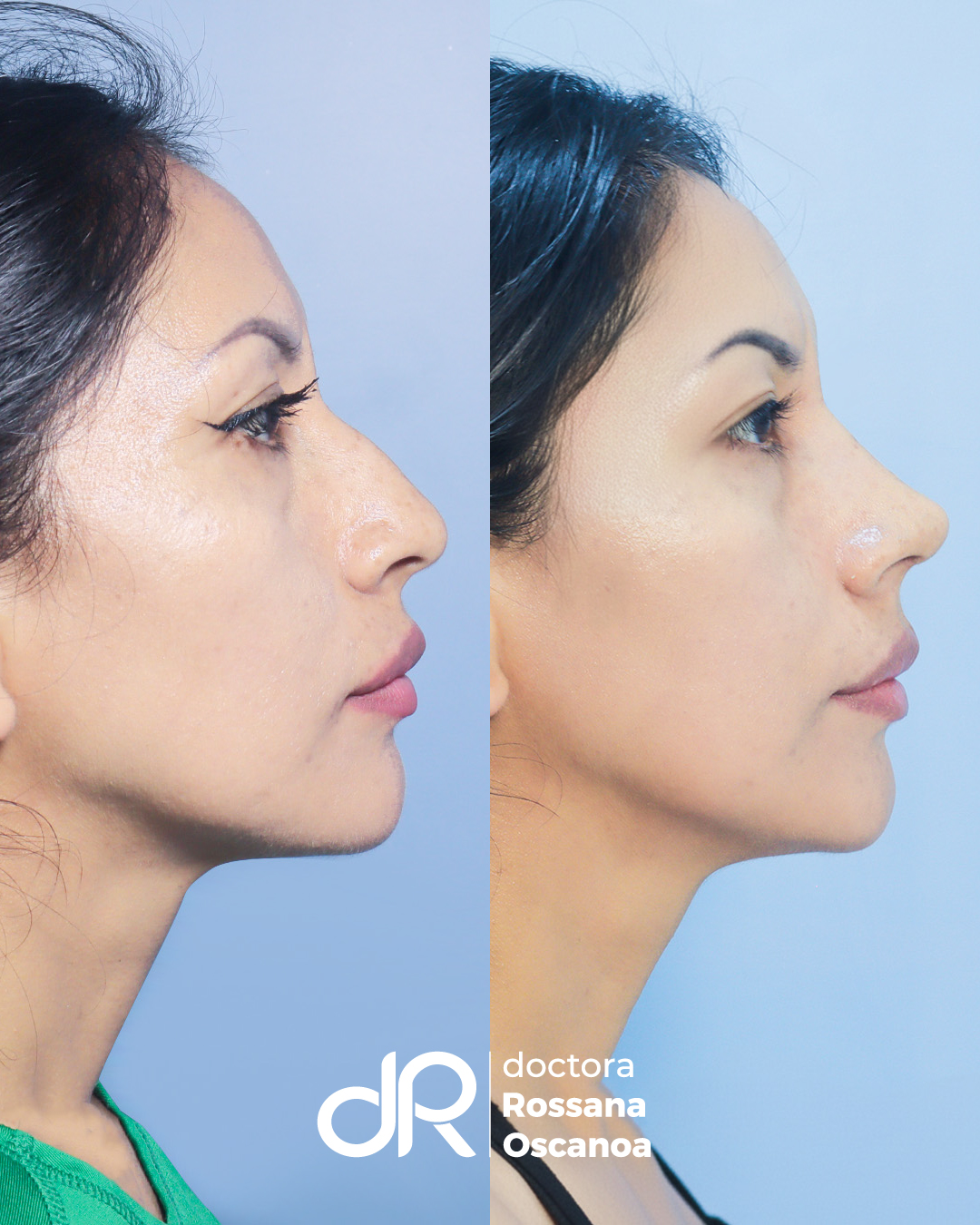 Antes y Después - Blefaroplastia