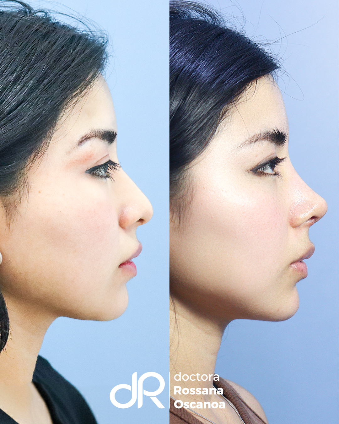Antes y Después - Lifting Facial