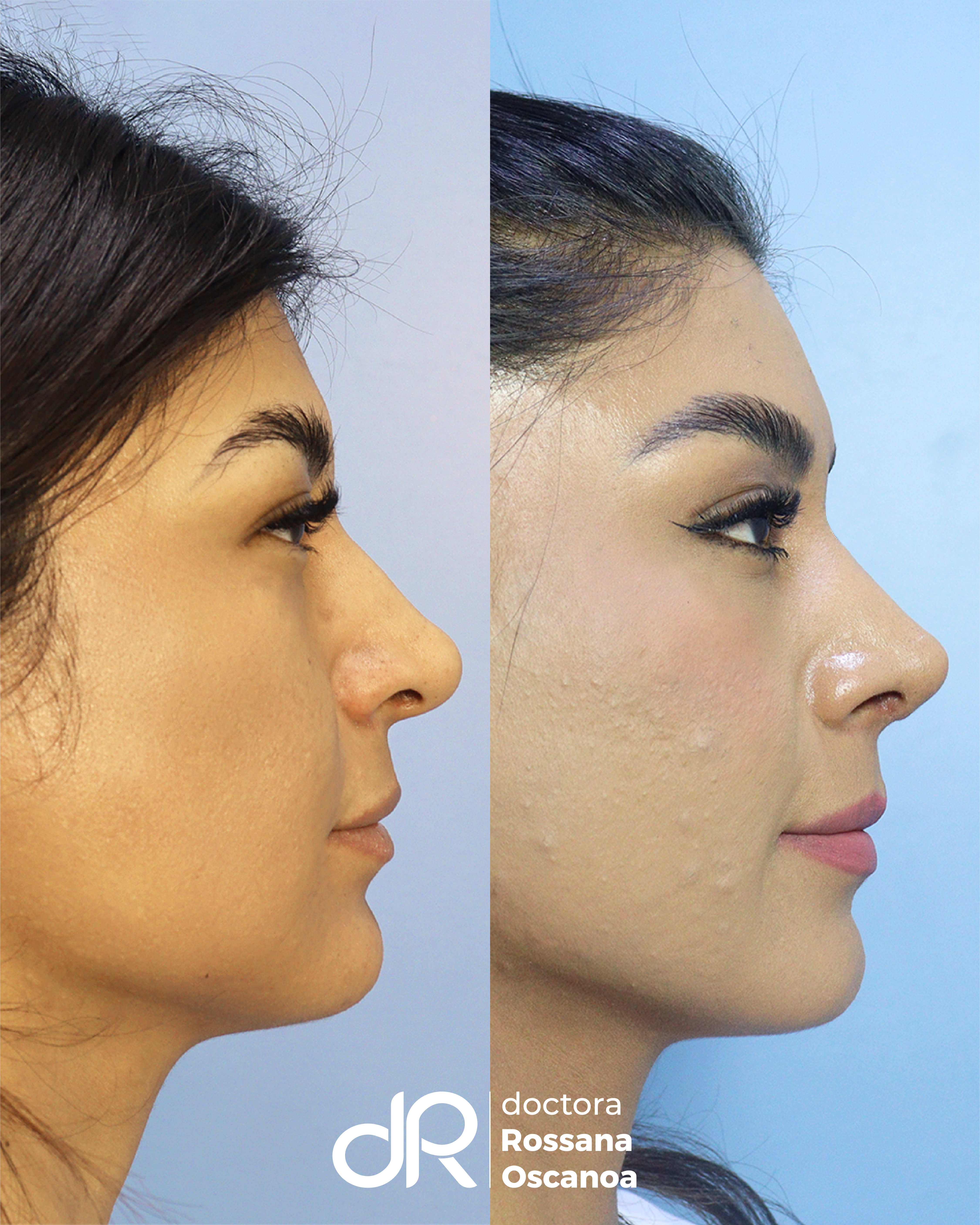 Antes y Después - Otoplastia